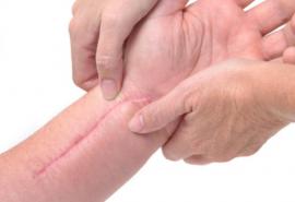 Recomendaciones para el manejo de cicatrices hipertróficas y queloides