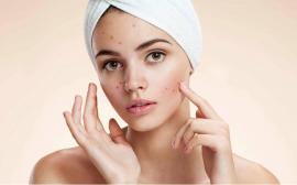 Tratamientos para cicatrices de acné