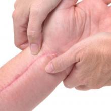Recomendaciones para el manejo de cicatrices hipertróficas y queloides